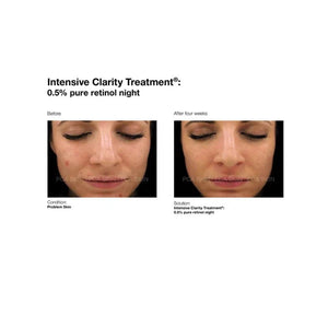 PCA Skin PCA Skin Intensive Clarity Treatment: 0.5% pure 29.5g Serums & Treatments