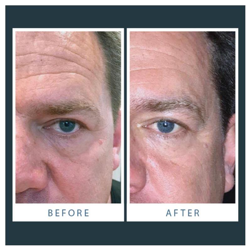 Wrinkles Schminkles Men s Eye Smoothing Kit AbsoluteSkin