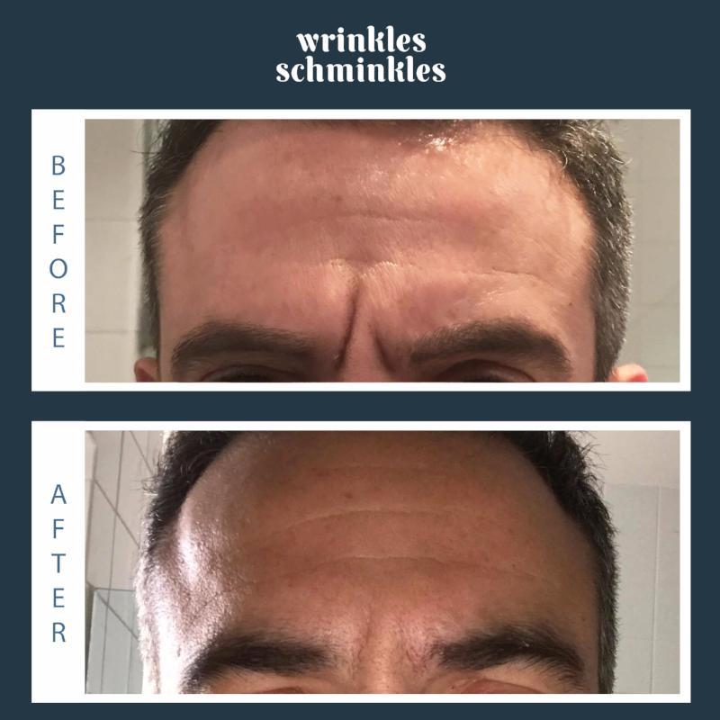 Wrinkles Schminkles Men's Forehead Smoothing Kit