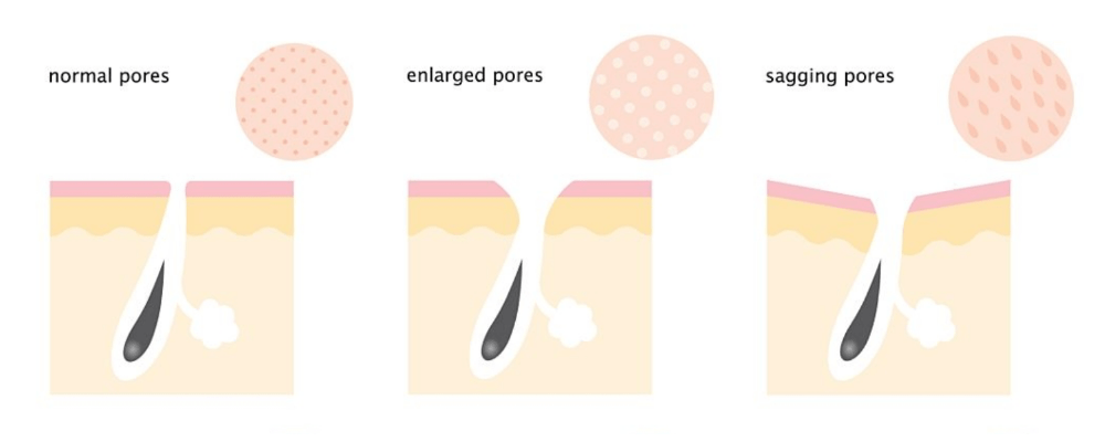 How to get rid of large pores - 6 products that will help