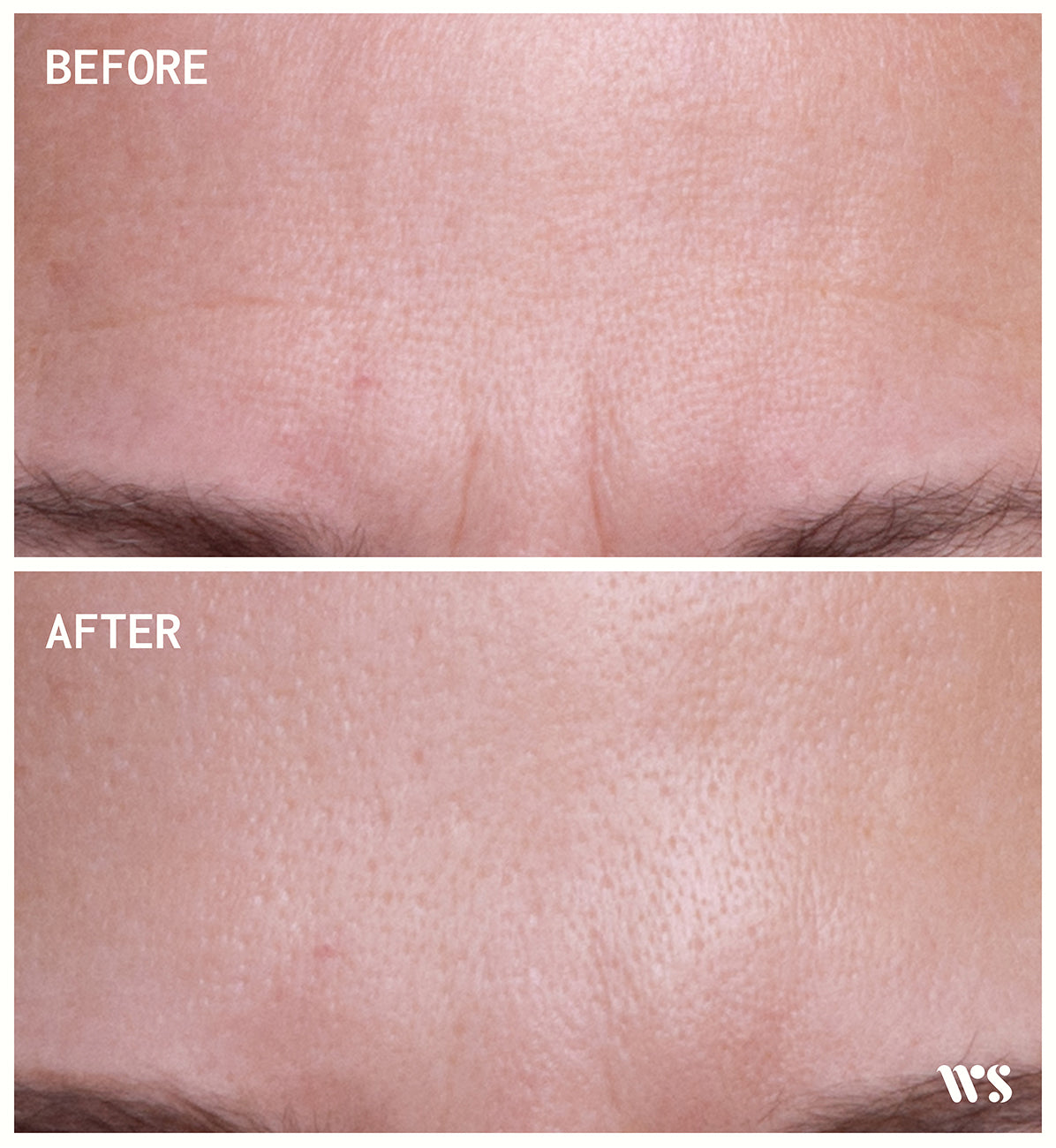 Wrinkles Schminkles Brow, Frown & Bunny Lines Wrinkle Patches - 2 Patches