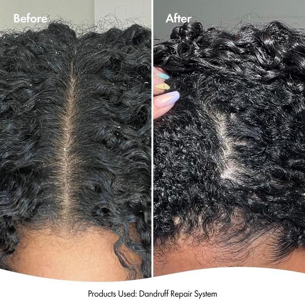 Bondi Boost Bondi Boost Dandruff Repair Leave In Scalp Serum 125ml Hair Treatments
