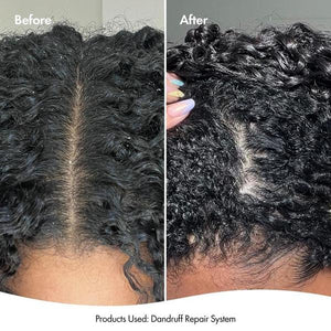 Bondi Boost Bondi Boost Dandruff Repair Leave In Scalp Serum 125ml Hair Treatments
