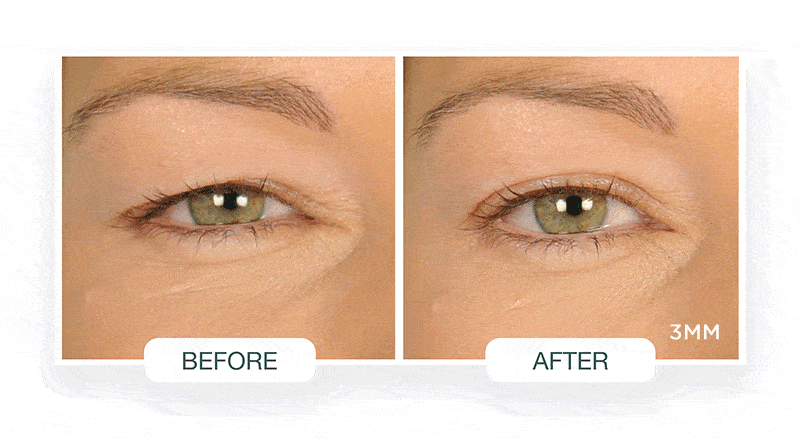 Contours RX Contours Rx Lids by Design 7mm Eye Lift Strips - 80 Pack Eye Treatments