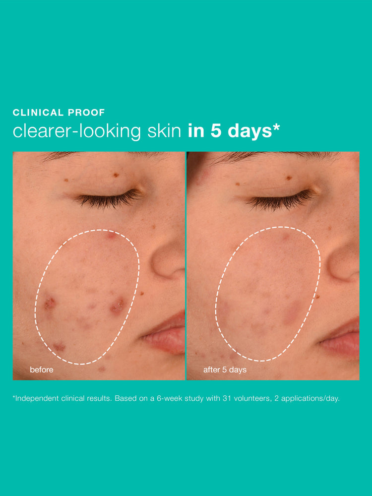 Dermalogica Dermalogica Breakout Biotic Moisturiser 50ml Moisturisers