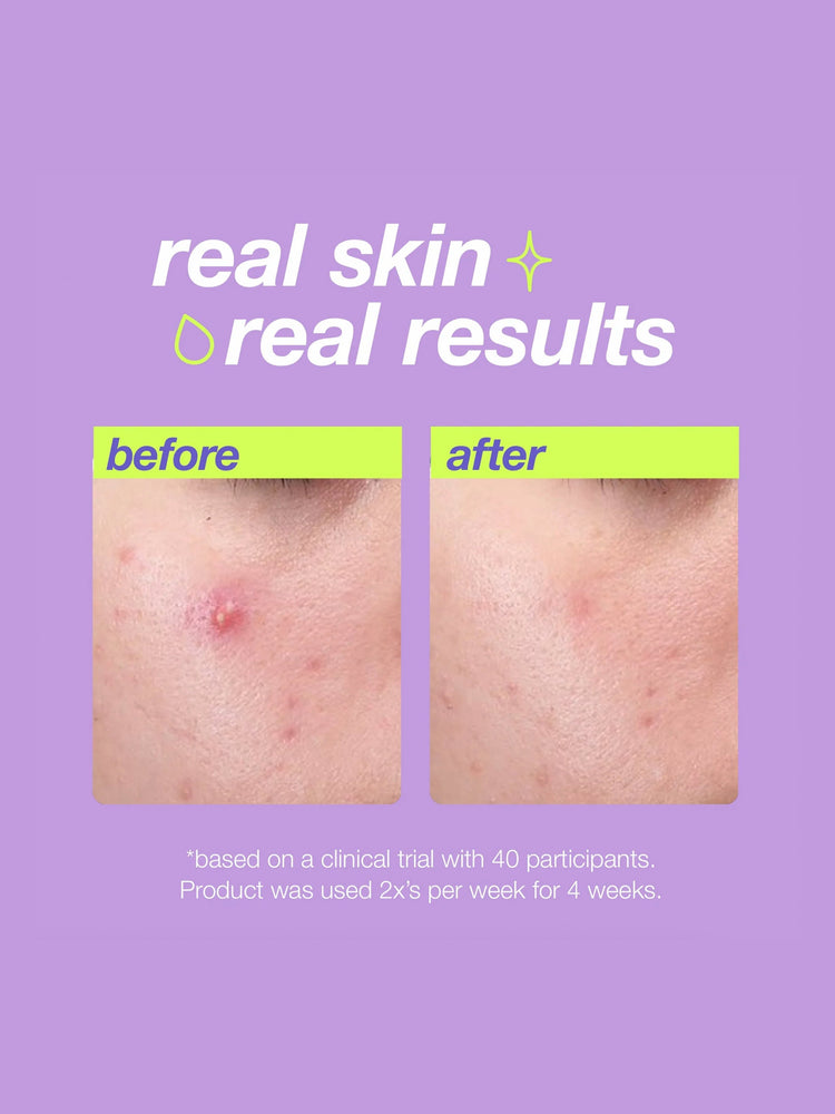 Dermalogica Dermalogica Clear Start Breakout Clearing Liquid Peel 30ml Serums & Treatments