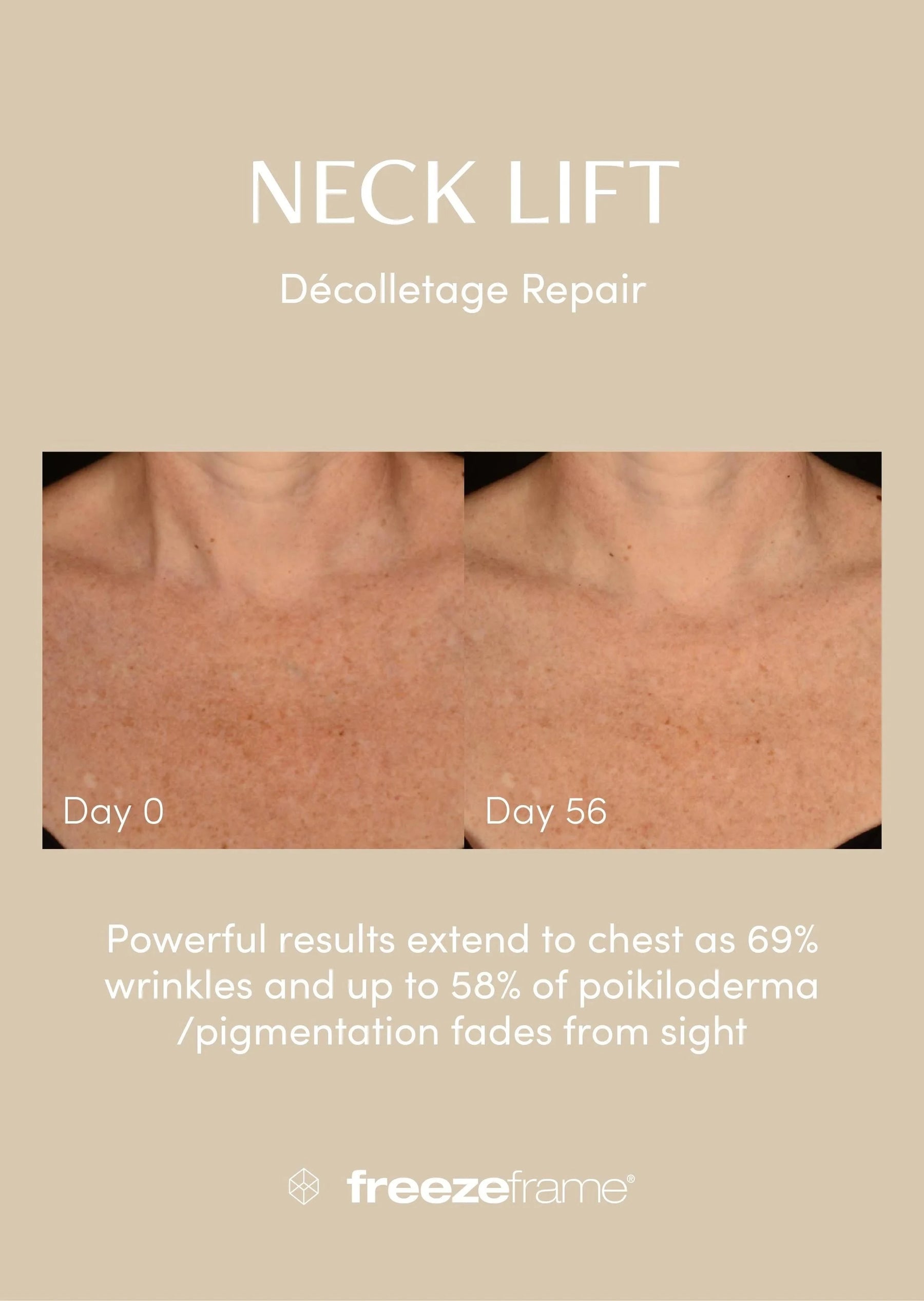 freezeframe freezeframe Neck Lift 50ml Neck & Decolletage