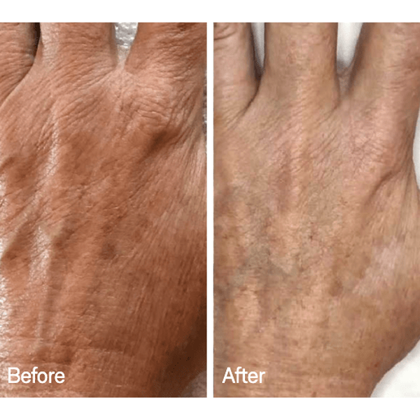 Omnilux Omnilux Contour Glove LED Light Therapy
