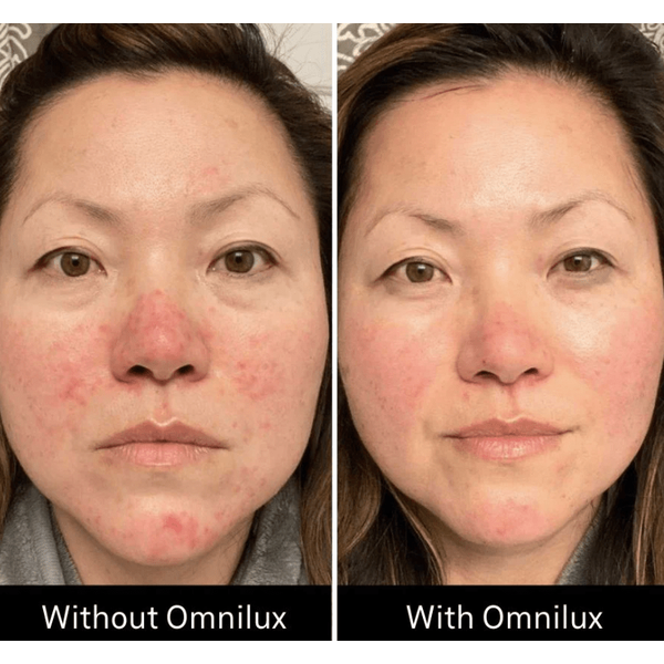 Omnilux Omnilux Contour Face