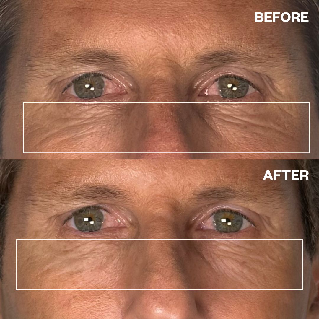 Wrinkles Schminkles Wrinkles Schminkles Men's Pro Eye Wrinkle Patches - 3 Pairs Skin Care
