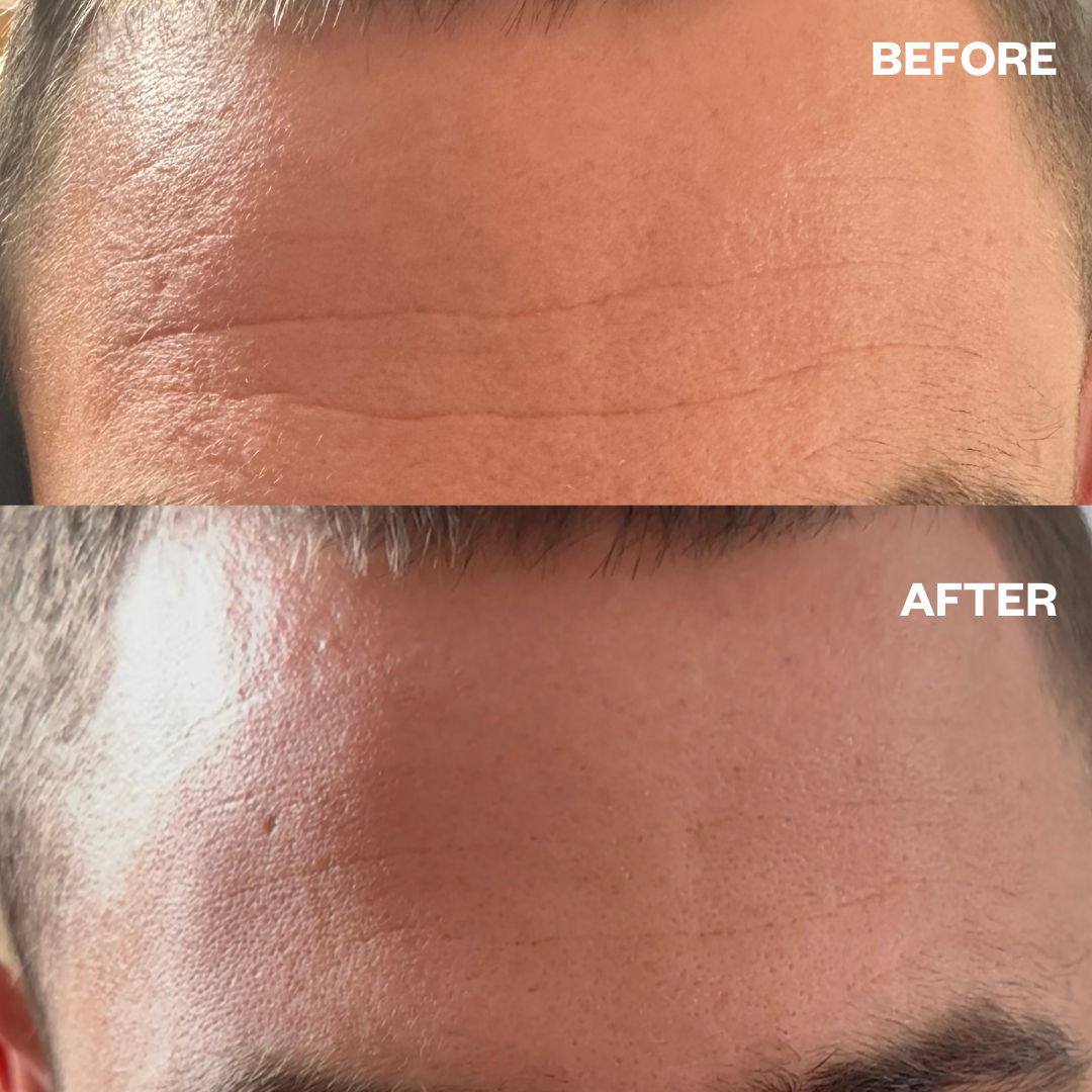 Wrinkles Schminkles Wrinkles Schminkles Men's Pro Forehead Wrinkle Patches - 2 Patches Skin Care