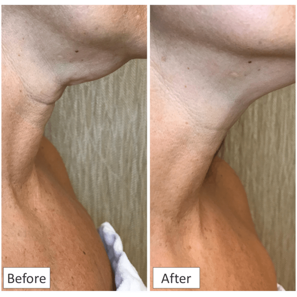 HydroPeptide Firm-a-Fix Nector Lifting Neck & Decollete Serum | primary image