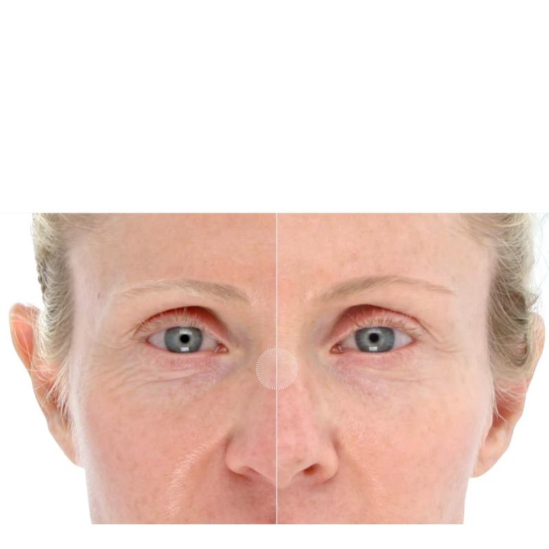 LightStim LED Light Therapy for Ageing