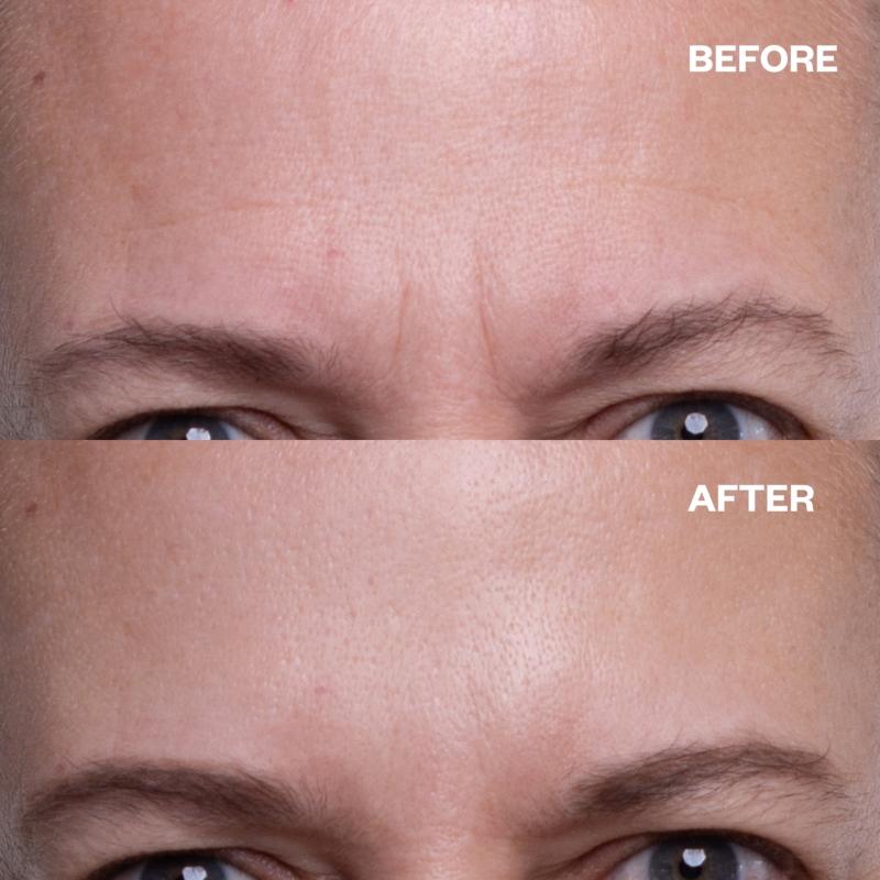 Wrinkles Schminkles Forehead Wrinkle Patch (1 patch) 